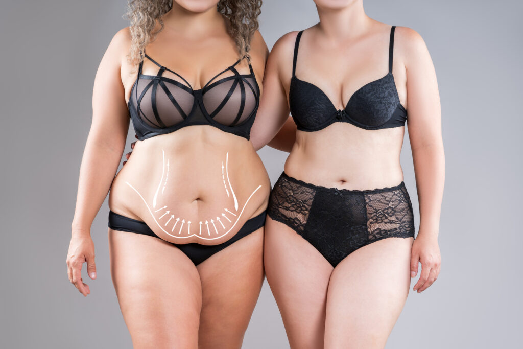 Plastická operácia brucha abdominoplastika