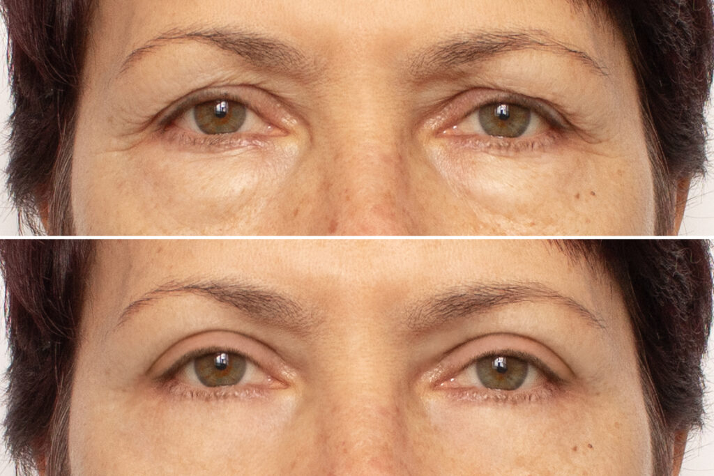 Blefaroplastika pred a po zákroku