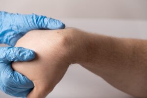 Odstránenie podkožných útvarov